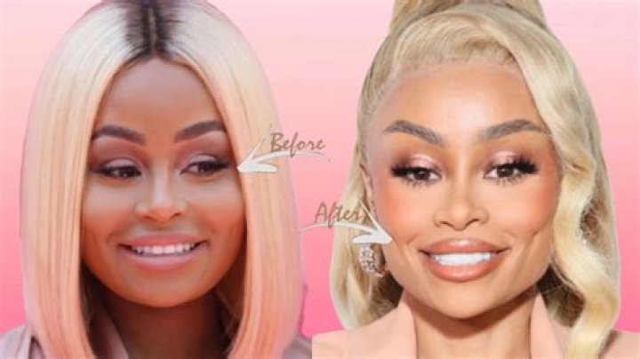 Blac Chyna's Journey Before Surgery